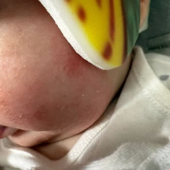 Cranial Kask Alerjik Reaksiyonuna Karşı İade Reddi Ve Sorumluluk İnkarı