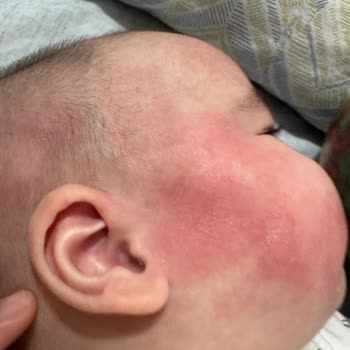 Cranial Kask Alerjik Reaksiyonuna Karşı İade Reddi Ve Sorumluluk İnkarı