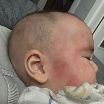 Cranial Kask Alerjik Reaksiyonuna Karşı İade Reddi Ve Sorumluluk İnkarı