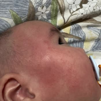 Cranial Kask Alerjik Reaksiyonuna Karşı İade Reddi Ve Sorumluluk İnkarı