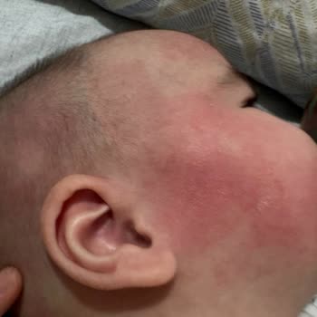 Cranial Kask Alerjik Reaksiyonuna Karşı İade Reddi Ve Sorumluluk İnkarı