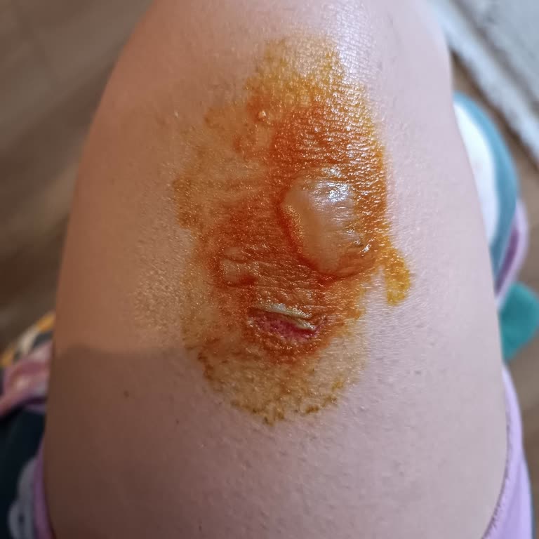 Gazzella Ütü Masasının Su Sızıntısı Bacağıma Kaynar Su Gelen Yanık