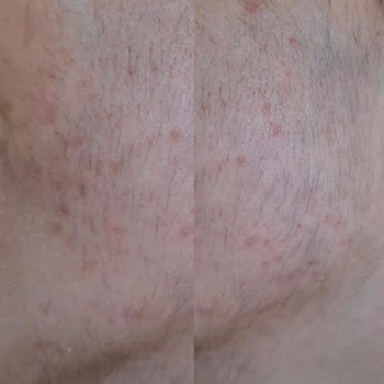 Elit Güzellik Salonu (Van) İğneli Epilasyon Sonrası Cilt Hasarı, Enfeksiyon Ve Skar