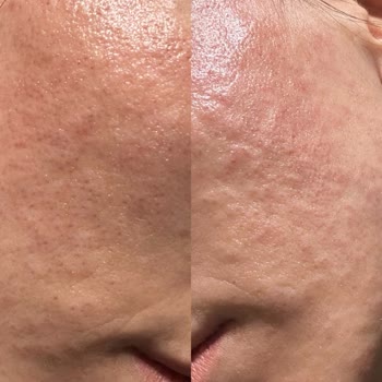 Elit Güzellik Salonu (Van) İğneli Epilasyon Sonrası Cilt Hasarı, Enfeksiyon Ve Skar