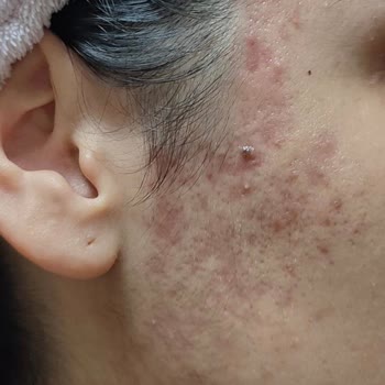 Elit Güzellik Salonu (Van) İğneli Epilasyon Sonrası Cilt Hasarı, Enfeksiyon Ve Skar