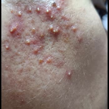 Elit Güzellik Salonu (Van) İğneli Epilasyon Sonrası Cilt Hasarı, Enfeksiyon Ve Skar