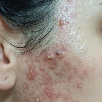 Elit Güzellik Salonu (Van) İğneli Epilasyon Sonrası Cilt Hasarı, Enfeksiyon Ve Skar