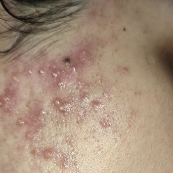 Elit Güzellik Salonu (Van) İğneli Epilasyon Sonrası Cilt Hasarı, Enfeksiyon Ve Skar