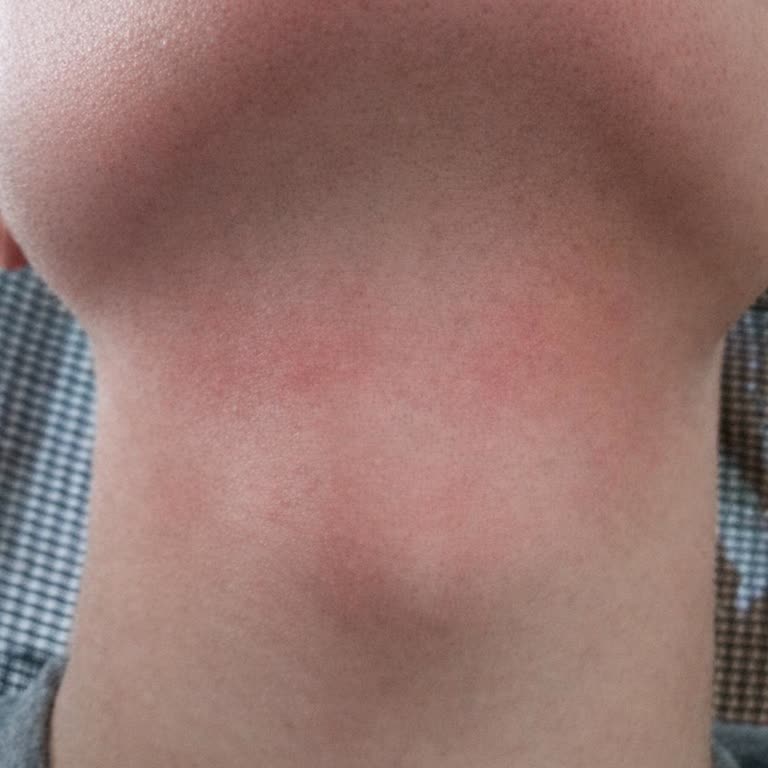 Philips Tıraş Makinesinde Şiddetli Ağrı Ve Tahriş