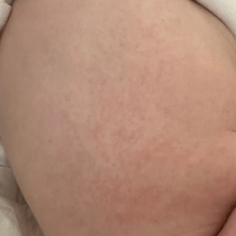 Johnson's Baby Aloe Veralı Yağda Cilt Tahrişi Ve İade Talebi