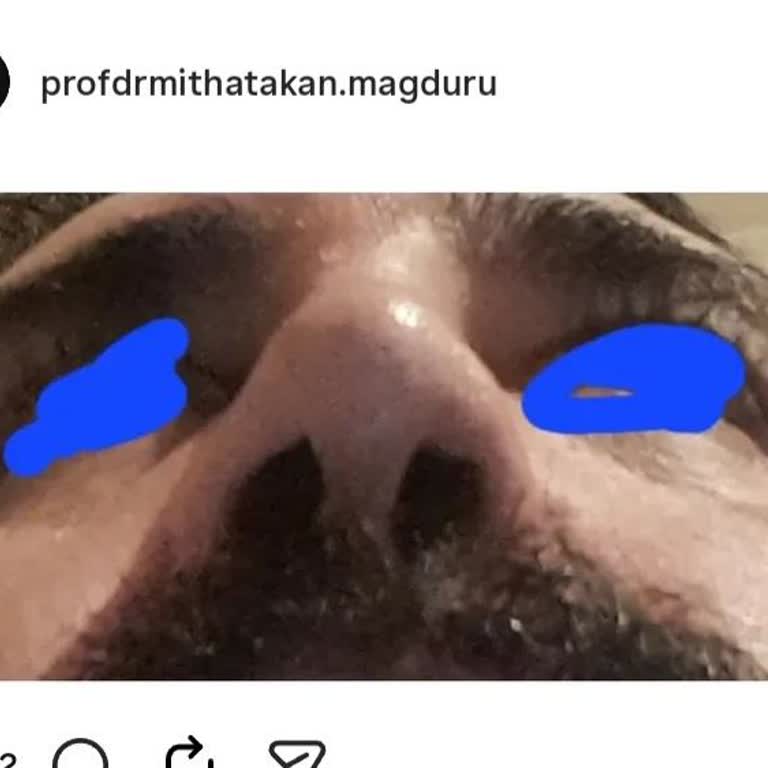 Burun Ameliyatı Sonrası Nefes Problemi Ve Estetik Sorunları İçin Çözüm Talebi