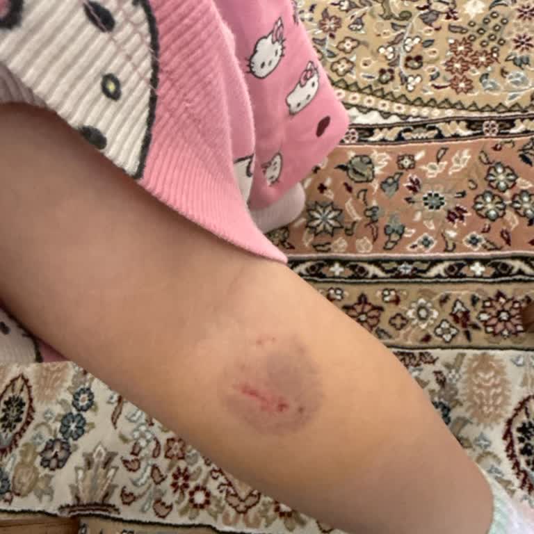 İstinyePark’ta Köpek Isırığı Çocuğumu Kuduz Aşısı Sürecine Sürükledi