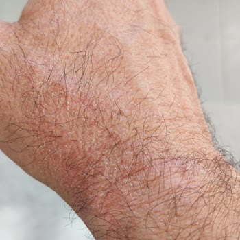 Duru Mutluluk Sabunu Ellerde Şiddetli Kızarıklık Ve Kaşıntı Yarattı