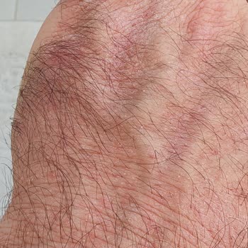 Duru Mutluluk Sabunu Ellerde Şiddetli Kızarıklık Ve Kaşıntı Yarattı