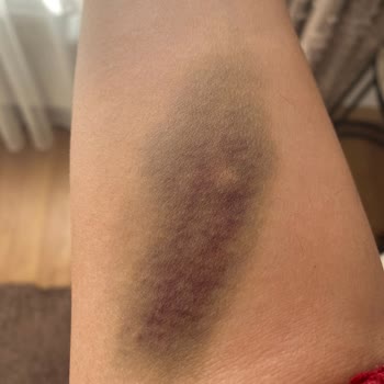 Erzurum Özel Buhara Hastanesinde Randevu Gecikmesi Ve Damar Açma İşlemindeki İhmalkarlık