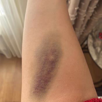 Erzurum Özel Buhara Hastanesinde Randevu Gecikmesi Ve Damar Açma İşlemindeki İhmalkarlık