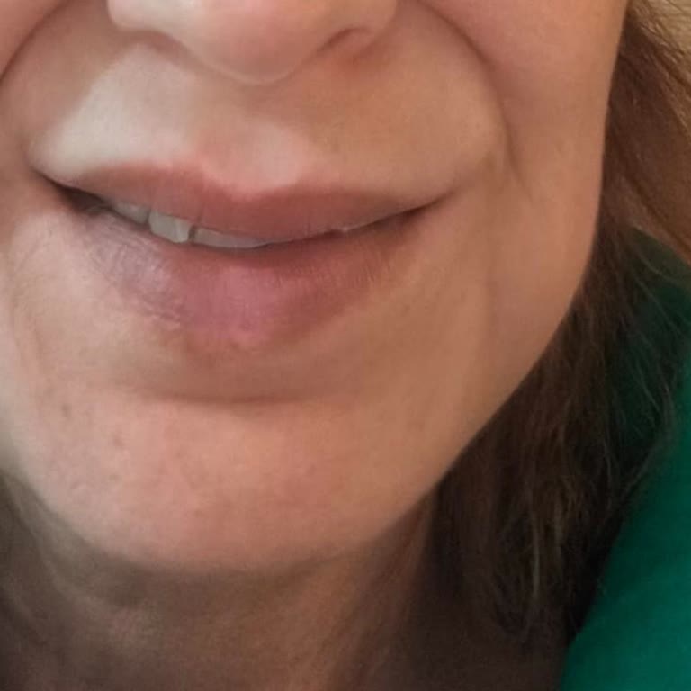 Op. Dr. Kaan Akacun Yüz Felci Geçirmiş Gibi Yamuldu Ve Şişti, Yemek Yiyemez, Su İçemez Hale Geldim