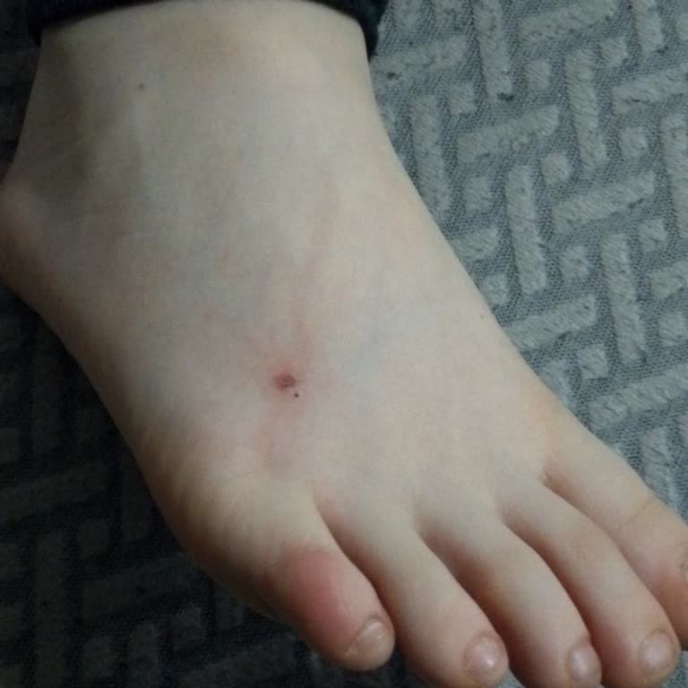 Çocuk Ayakkabısının Yara Açması Ve İade Reddi