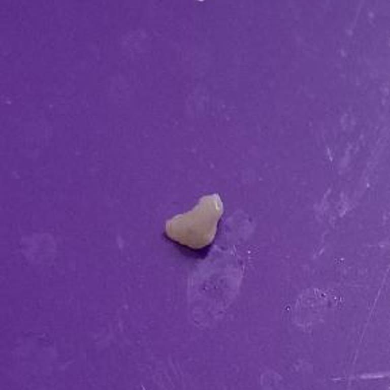 Migros’ta Satın Alınan Köfte İçindeki Kemik Parçası Nedeniyle Diş Ağrısı Ve Kırığı Yaşadık