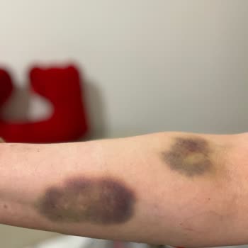 Üsküdar Devlet Hastanesi Acil Serviste Yaşlı Hastanın Damar Yolu Açma İşlemi İçin Dört Deneme