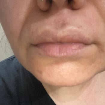 Muayenesiz İlaç Yazımı Nedeniyle Alerjik Reaksiyon Şikayeti