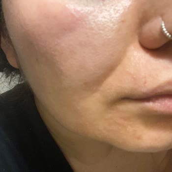 Muayenesiz İlaç Yazımı Nedeniyle Alerjik Reaksiyon Şikayeti