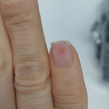 Bahar Acar Güzellik Merkezi’nde İşini Bilmeyen Personel Nedeniyle Tırnaklarda Şiddetli Hasar