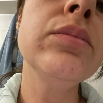 Yves Rocher Ürünleri Yüzümde Sivilceye Neden Oldu Ve İade Talebim Cevapsız