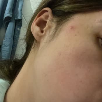 Yves Rocher Ürünleri Yüzümde Sivilceye Neden Oldu Ve İade Talebim Cevapsız