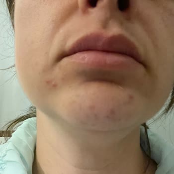 Yves Rocher Ürünleri Yüzümde Sivilceye Neden Oldu Ve İade Talebim Cevapsız