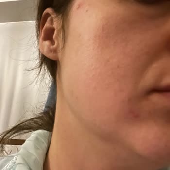 Yves Rocher Ürünleri Yüzümde Sivilceye Neden Oldu Ve İade Talebim Cevapsız