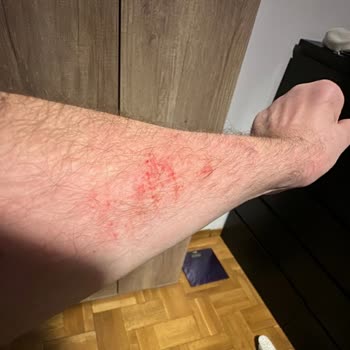 Baymak Servisinde Randevu Gecikmesi, Hatalı Montaj Ve Müşteri Yaralanması