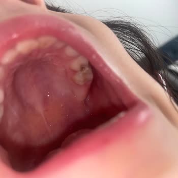 Narlıdere Çocuk Diş Hekiminin Saygısız Tutumu Ve Tedavi İptali Kızımın Ağrısını Uzattı