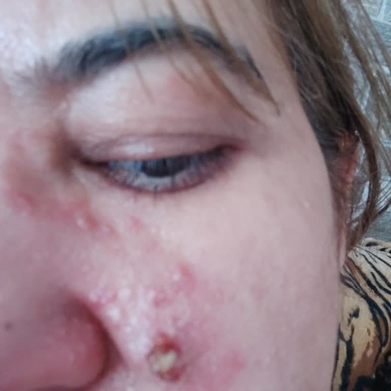 Pharmaceris Güneş Kreminde Alerjik Reaksiyon Ve Ücret İadesi Talebi!