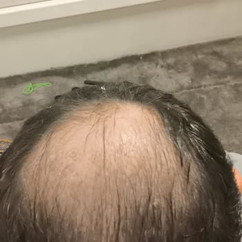 Dymed Hair Clinic Donör Yetersizliği Nedeniyle Tepe Ekim Yapılmadı