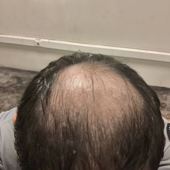 Dymed Hair Clinic Donör Yetersizliği Nedeniyle Tepe Ekim Yapılmadı