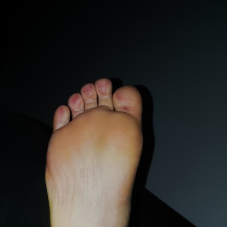 Ayakkabının Logo Yırtılması Ve Mantar Problemi Nedeniyle Tam İade Talebi