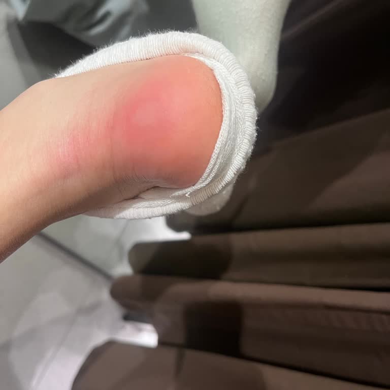 FLO Botu Ayağımı Mahvetti, Şiddetli Topuk Ağrısı Ve Sağlık Sorunu