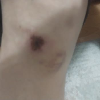 Kaygan Tabanlı Spor Ayakkabı Nedeniyle Düşme Ve İade Talebi