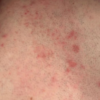 Daycare Tüy Dökücü Kremin Yanması Ve Ürün Güvenliği Şüphesi