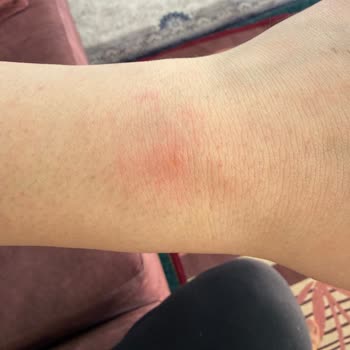 Daycare Tüy Dökücü Kremin Yanması Ve Ürün Güvenliği Şüphesi