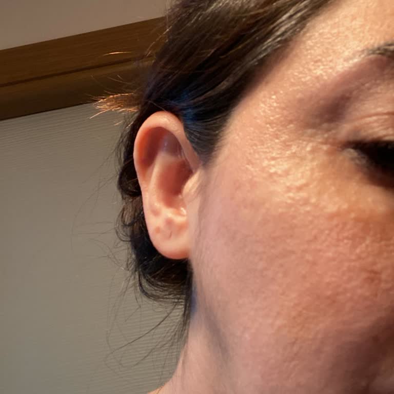 Bioderma Photoderm M Güneş Kremi Ciltte Pütürcük Ve Yanma Oluştu