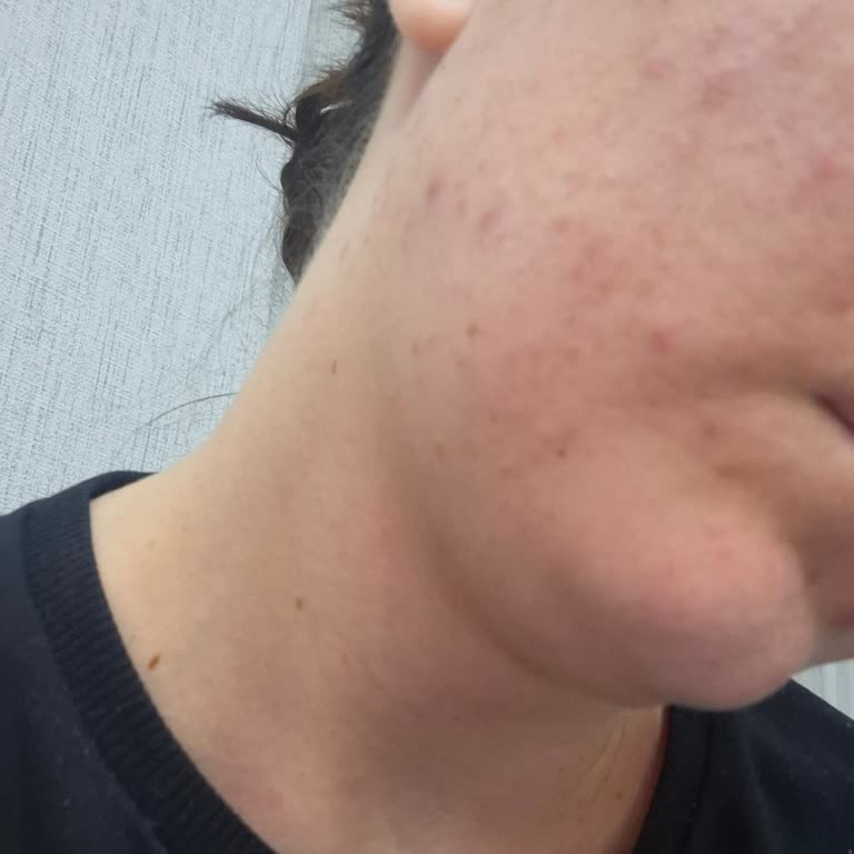 Celenes By Sweden Yüz Jelinde Şiddetli Yanma Ve Kızarıklık