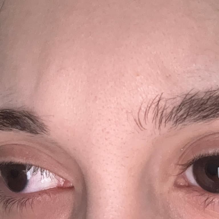 Liva Clinic (Bakırköy) Geçmeyen Şişlikler Oluştu ve Hâlâ Devam Ediyor