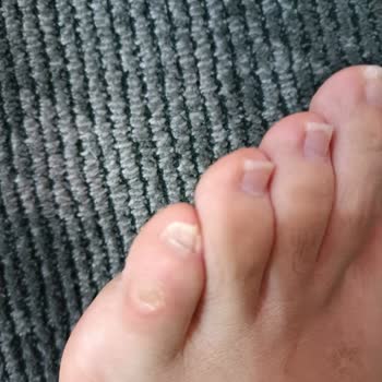 Nasır Oluşturan Skechers Ayakkabısı Ve Mağazanın İade Reddi