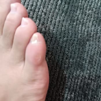 Nasır Oluşturan Skechers Ayakkabısı Ve Mağazanın İade Reddi