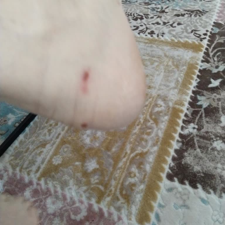 Yeni Bot Ayağımda Yara Oluşturdu, Ücret İadesi Talebi