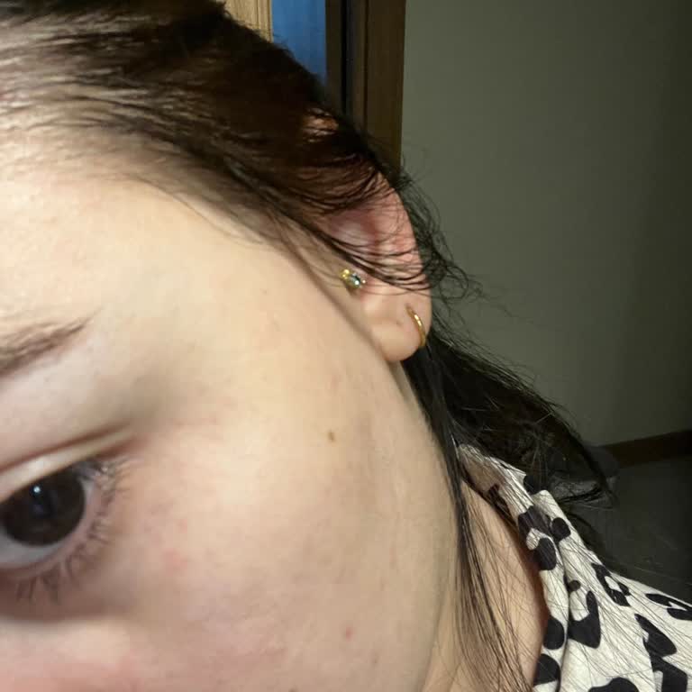 Rossmann Isana Augen Roll-On Ürünü Dermatolojik İddialara Rağmen Alerjik Reaksiyon Yarattı