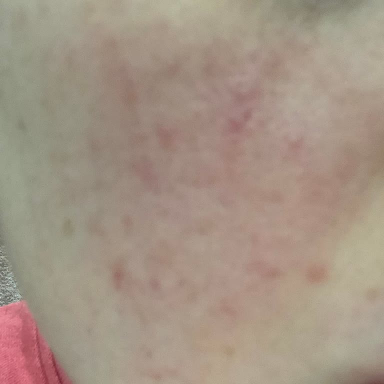 Vichy Dercos Şampuanı Ciltte Sivilcelere Neden Oldu, İade Ve Tam Geri Ödeme Talebi