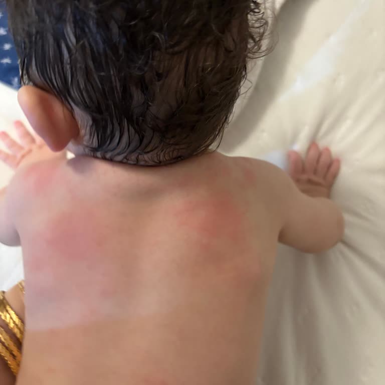 Hipp Combiotic Mama Değişikliği Sonrası Bebekte Şiddetli Alerjik Reaksiyon Ve Güvenlik Talebi